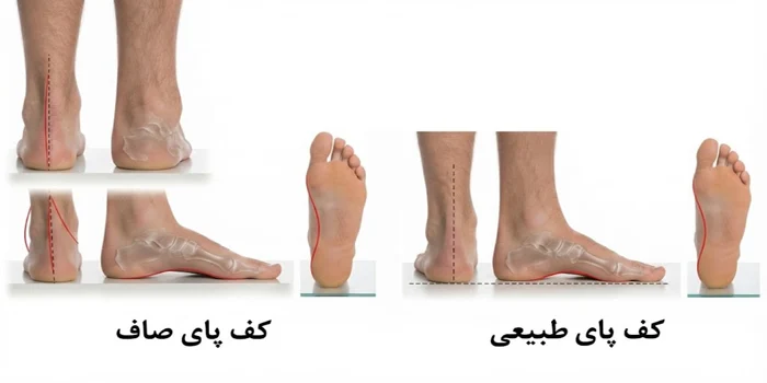 انواع فرم پا در افراد 6546531